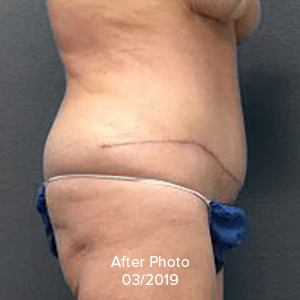 Tummy Tuck