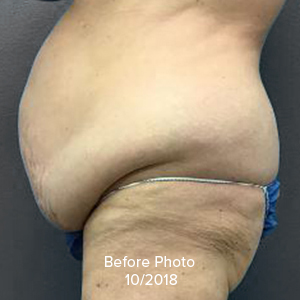 Tummy Tuck