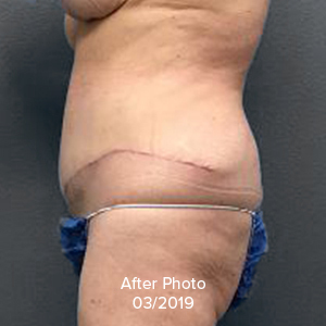 Tummy Tuck