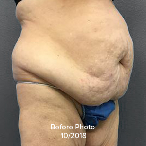 Tummy Tuck