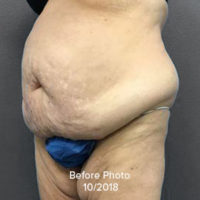 Tummy Tuck