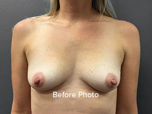 Breast Augmentation