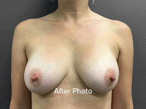 Breast Augmentation