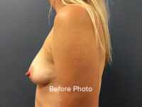 Breast Augmentation