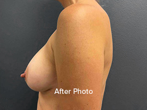 Breast Augmentation