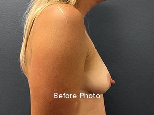 Breast Augmentation