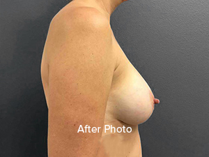 Breast Augmentation