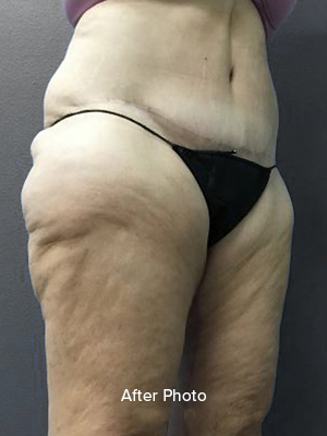 Medial Thigh Lift