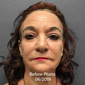 Browlift