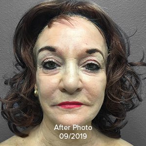 Browlift