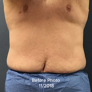 Liposuction