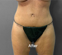 Tummy Tuck