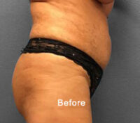 Tummy Tuck