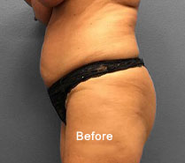 Tummy Tuck