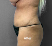 Tummy Tuck