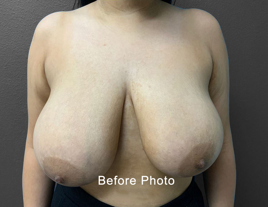 Breast Reduction