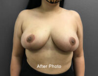 Breast Reduction