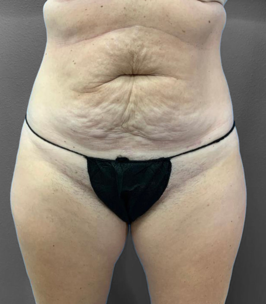 Tummy Tuck