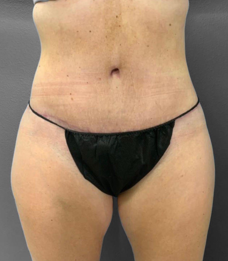 Tummy Tuck