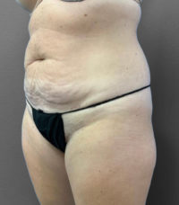 Tummy Tuck