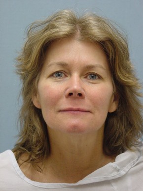 Facial Fat Grafting