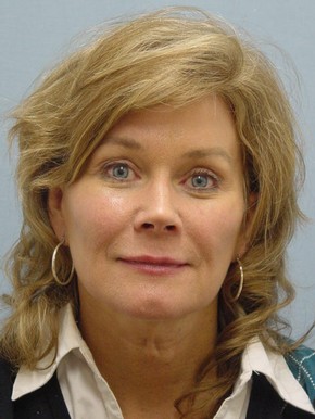 Facial Fat Grafting