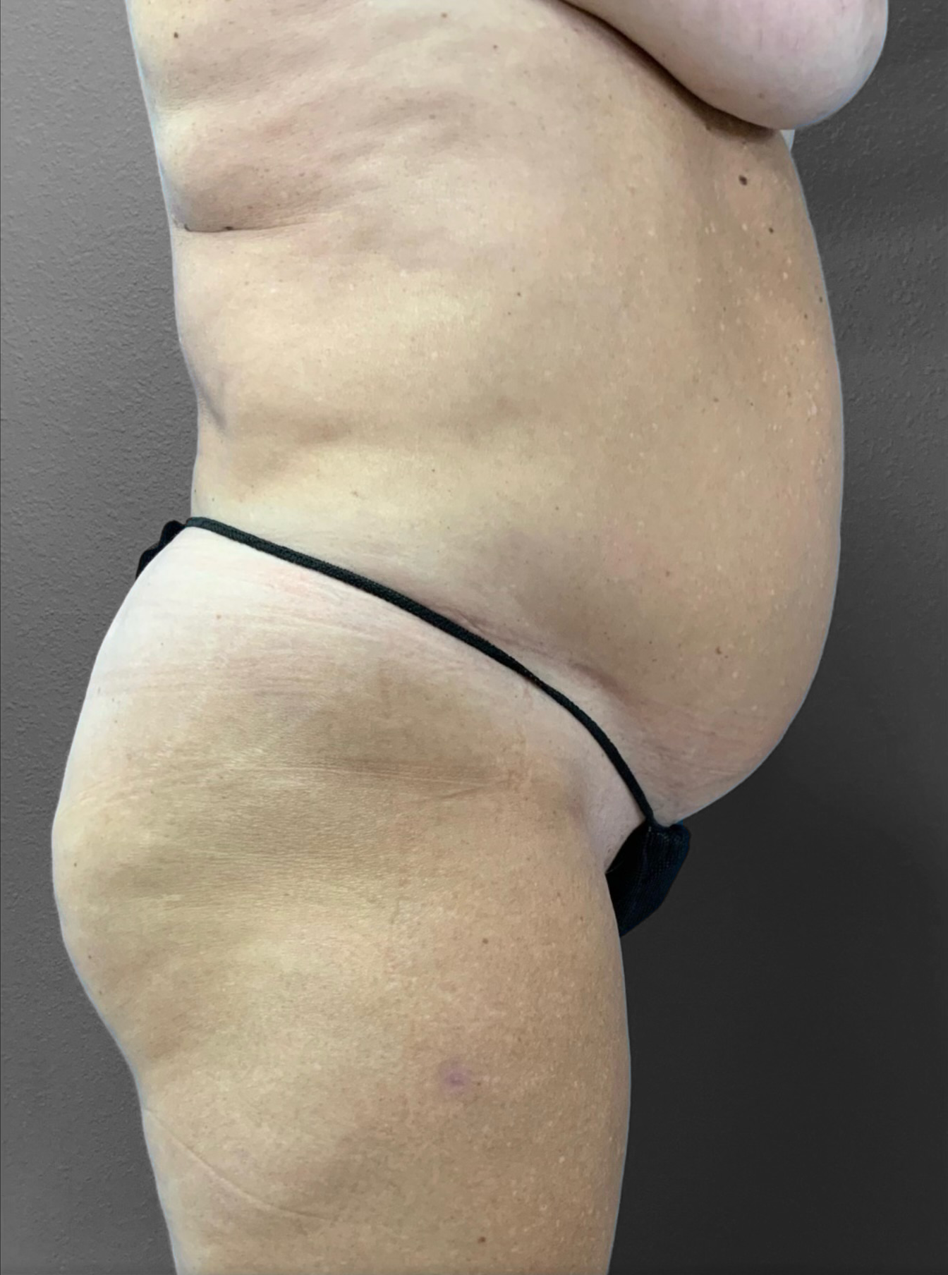 Liposuction