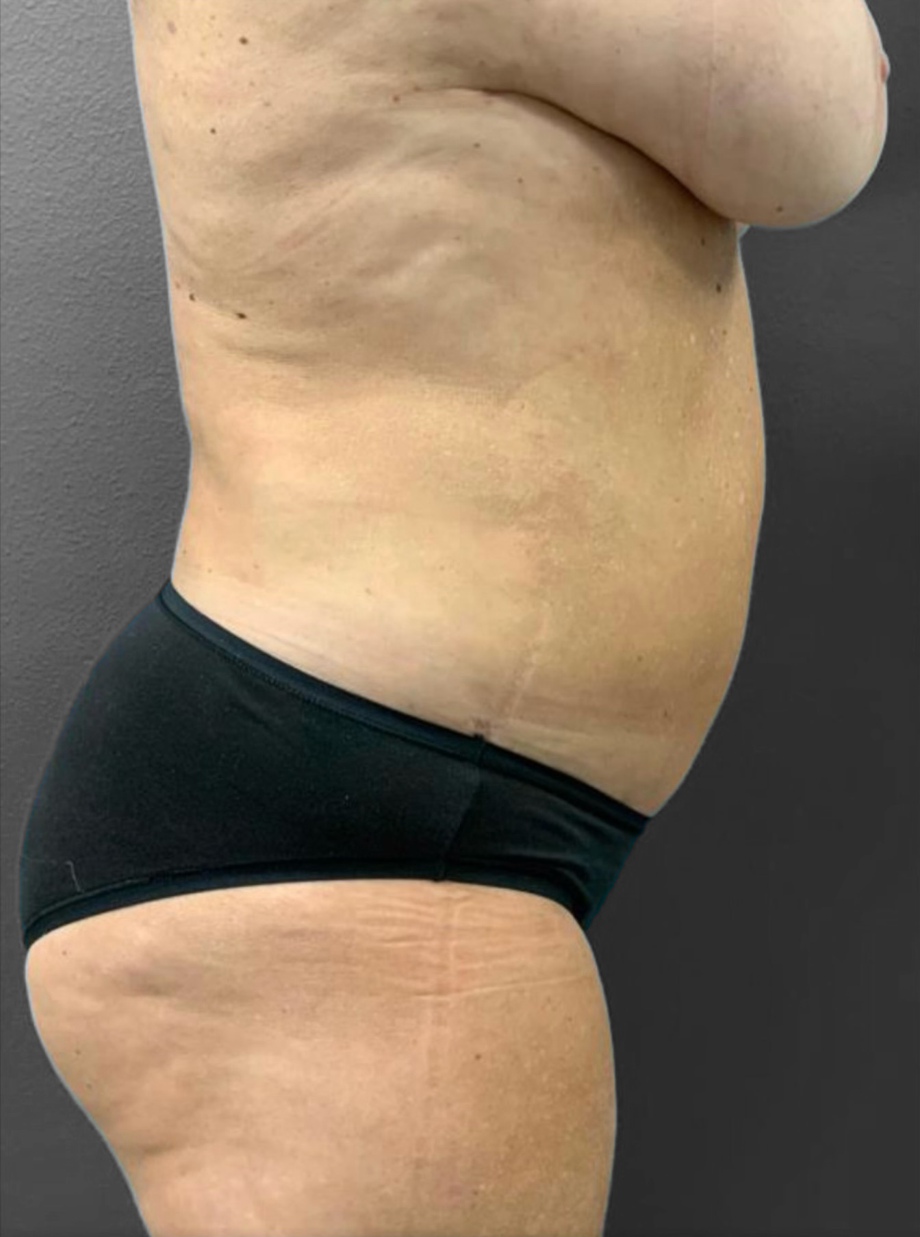 Liposuction