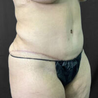 Tummy Tuck