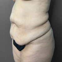Tummy Tuck