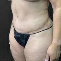 Tummy Tuck