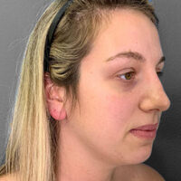 Rhinoplasty