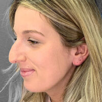 Rhinoplasty