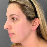 Rhinoplasty