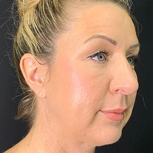 Rhinoplasty