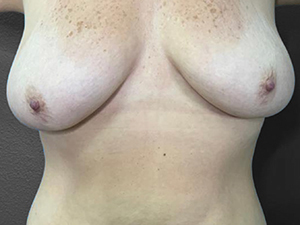 Breast Lift