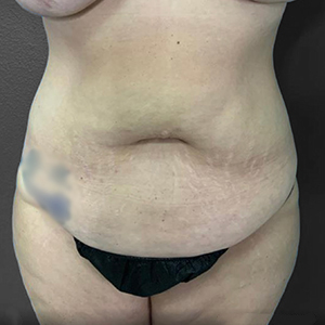 Tummy Tuck