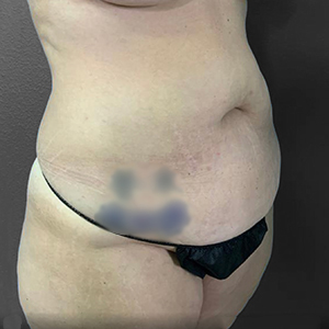 Tummy Tuck