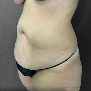 Tummy Tuck