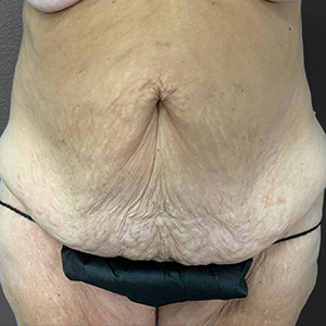 Tummy Tuck