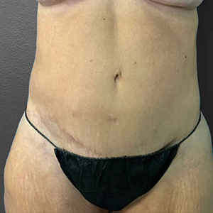 Tummy Tuck