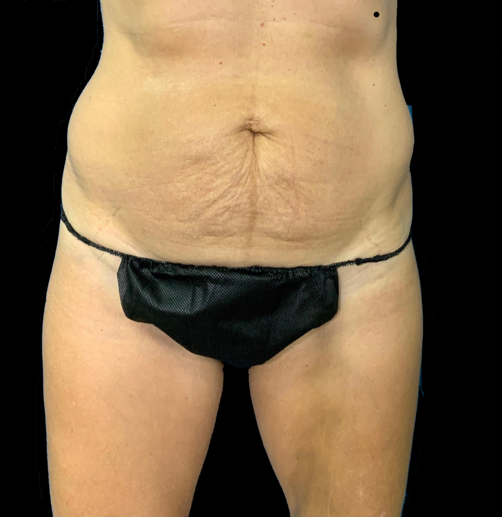 Tummy Tuck