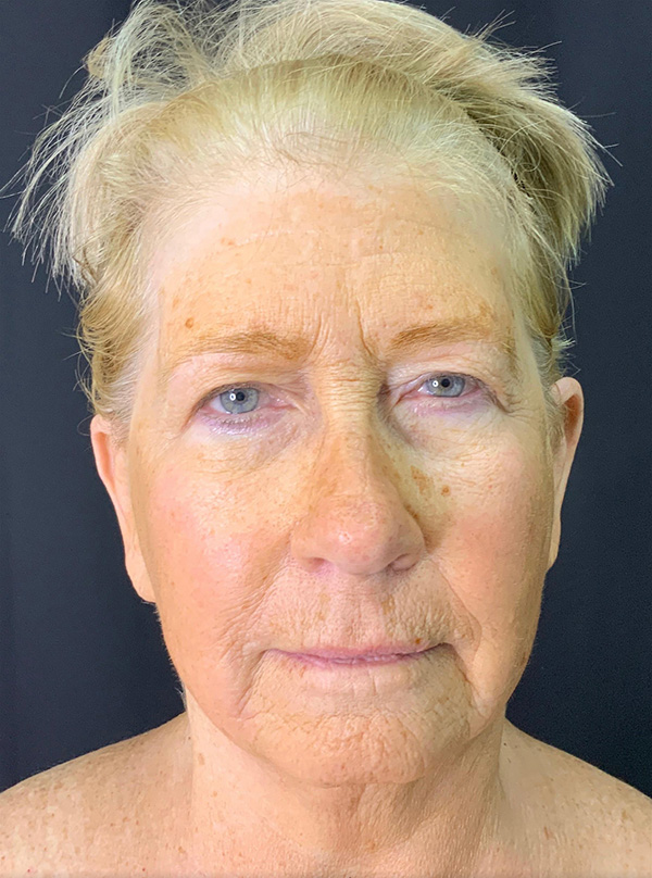 Browlift/Blepharoplasty