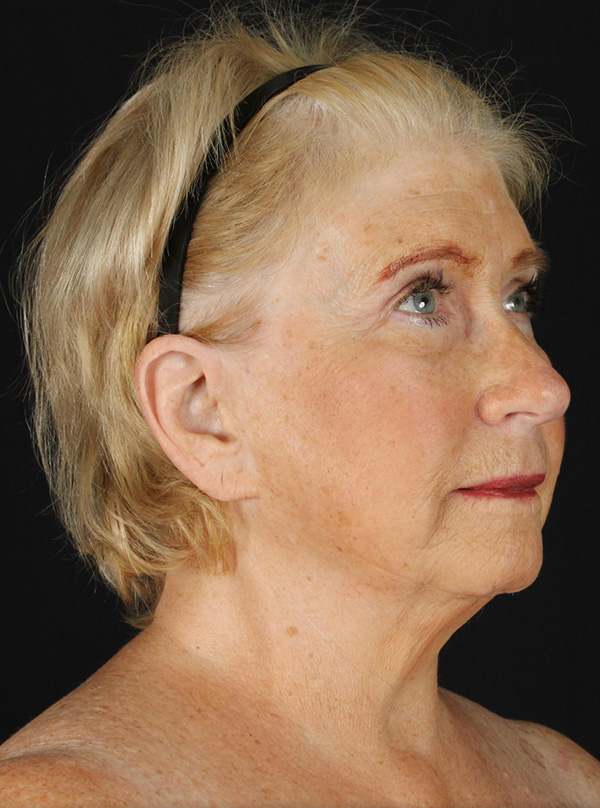 Browlift/Blepharoplasty