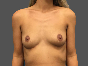 Breast Augmentation