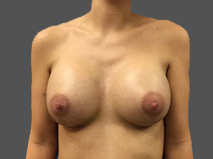 Breast Augmentation