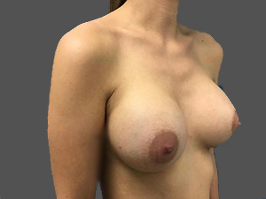 Breast Augmentation