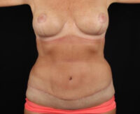 Tummy Tuck