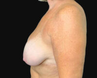 Breast Reduction