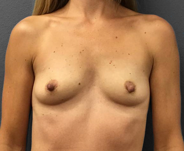 Breast Augmentation